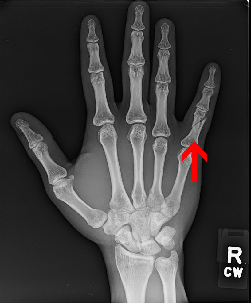 Compound Fracture Of The Finger Bones Causes Symptoms