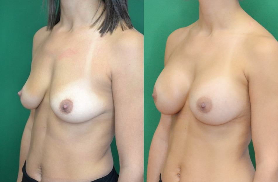 breast augmentation case study