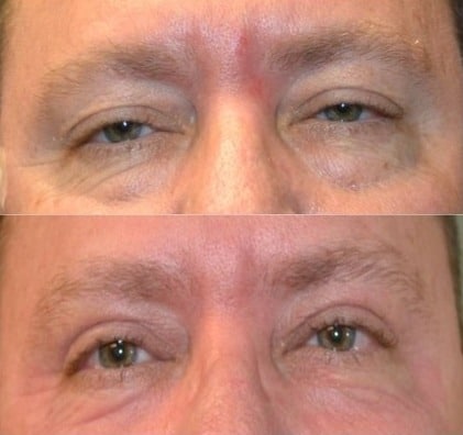 Eyelid Surgery Before and After old