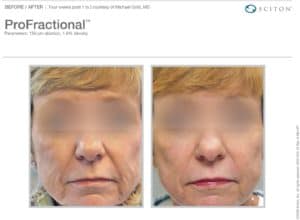 ProFractional laser treatment