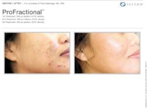 ProFractional laser treatment for acne