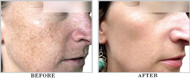 Real BBL Before and After Photos | NOVA Plastic Surgery and Dermatology