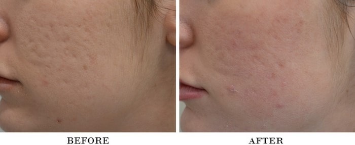 Acne scars actual patient results 1