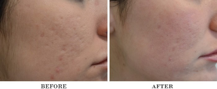 Acne scars actual patient results 2