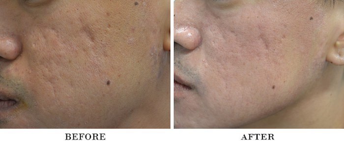 Acne scars actual patient results 3