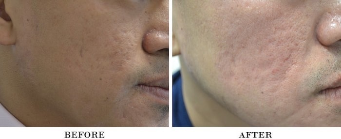 Acne scars actual patient results 4