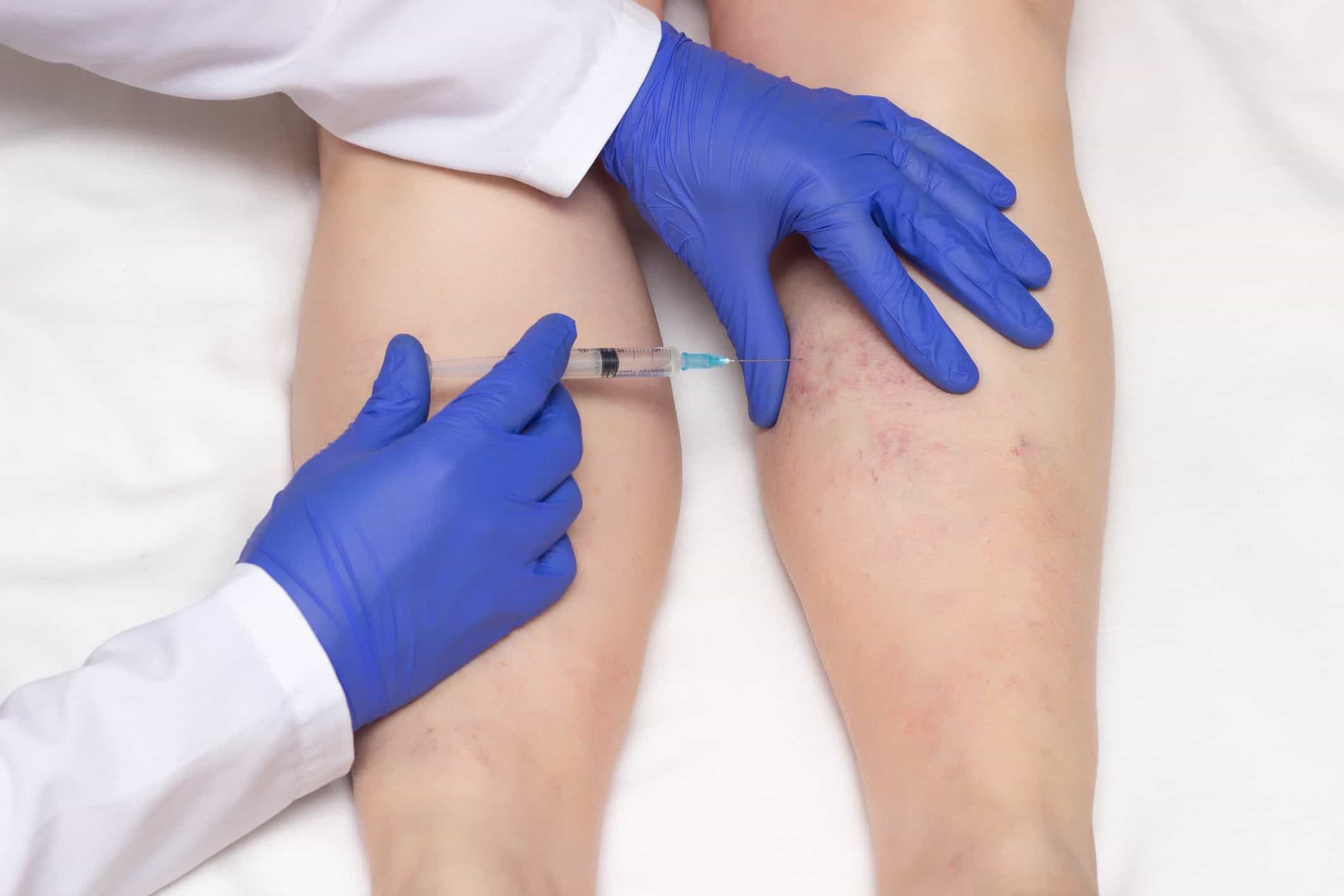 What Is Sclerotherapy and Is it Right for Me?