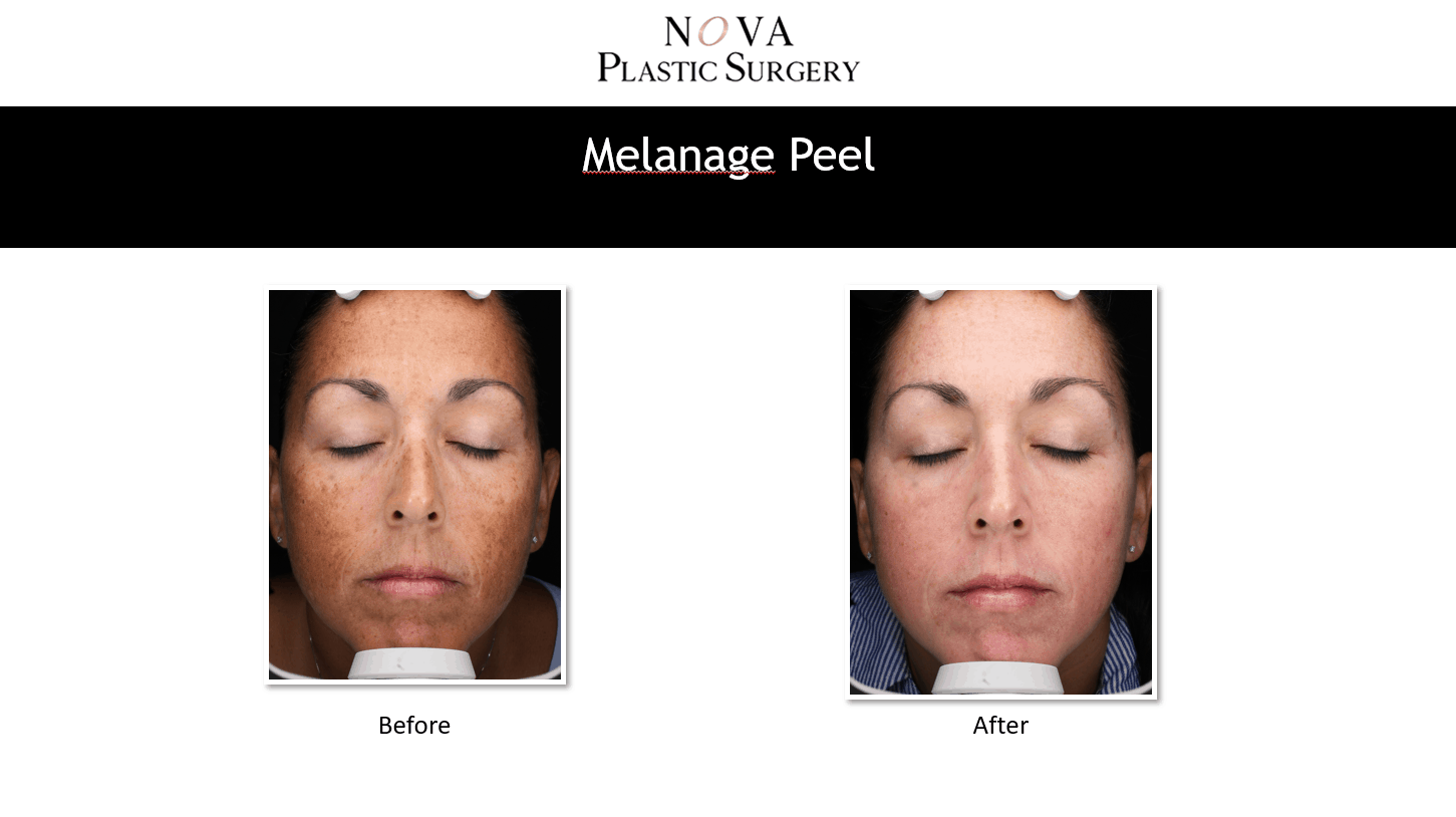 melanage peel near me
