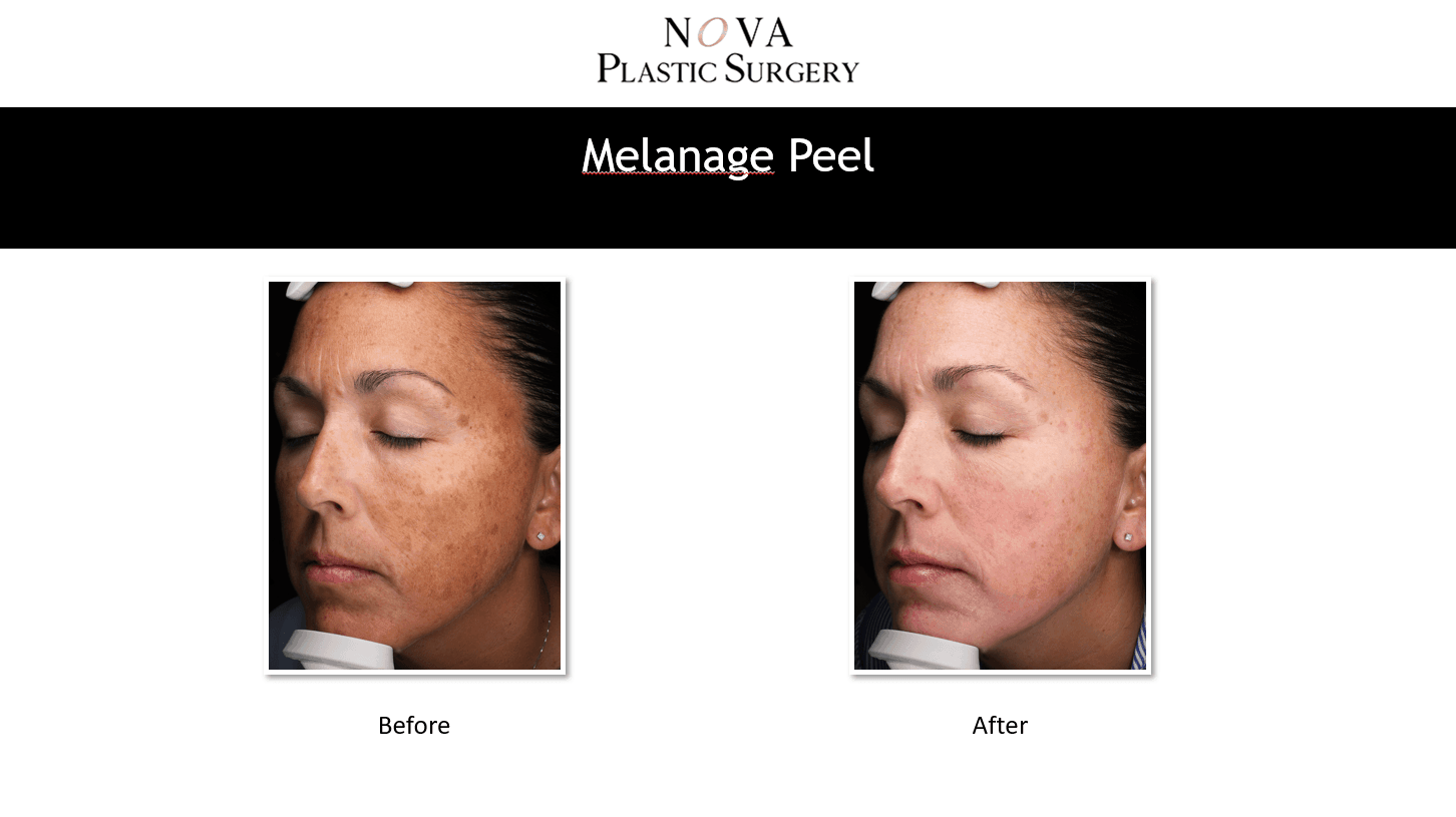 Melasma Treatments Hyperpigmentation Treatments In Northern Va