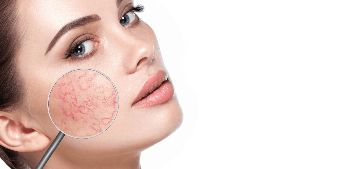 Spider Veins on face