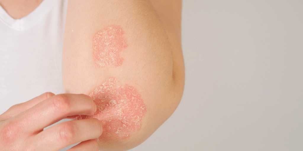 Psoriasis Vs Eczema Whats The Difference Nova Plastic Surgery And 