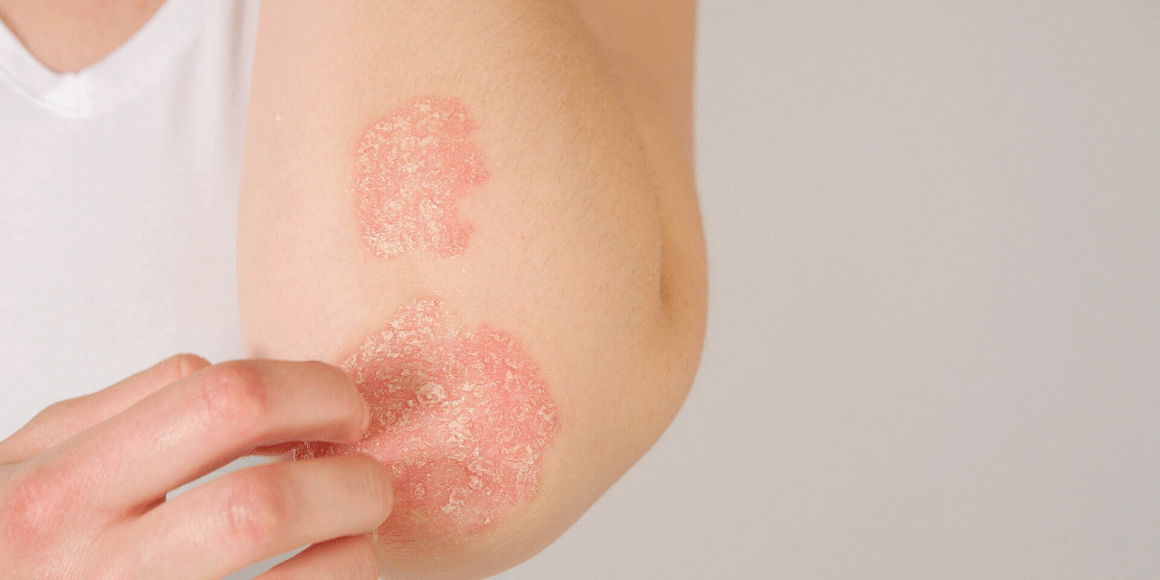 Psoriasis vs. Eczema