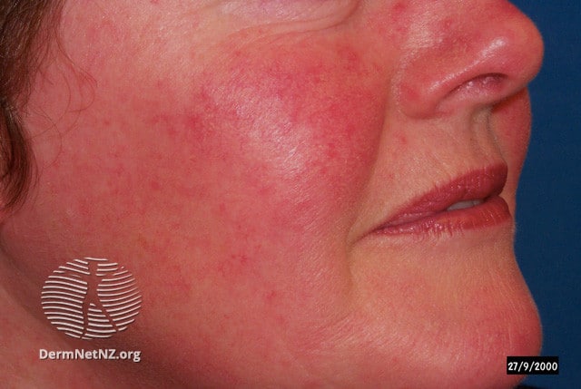 Rosacea And Perioral Dermatitis 