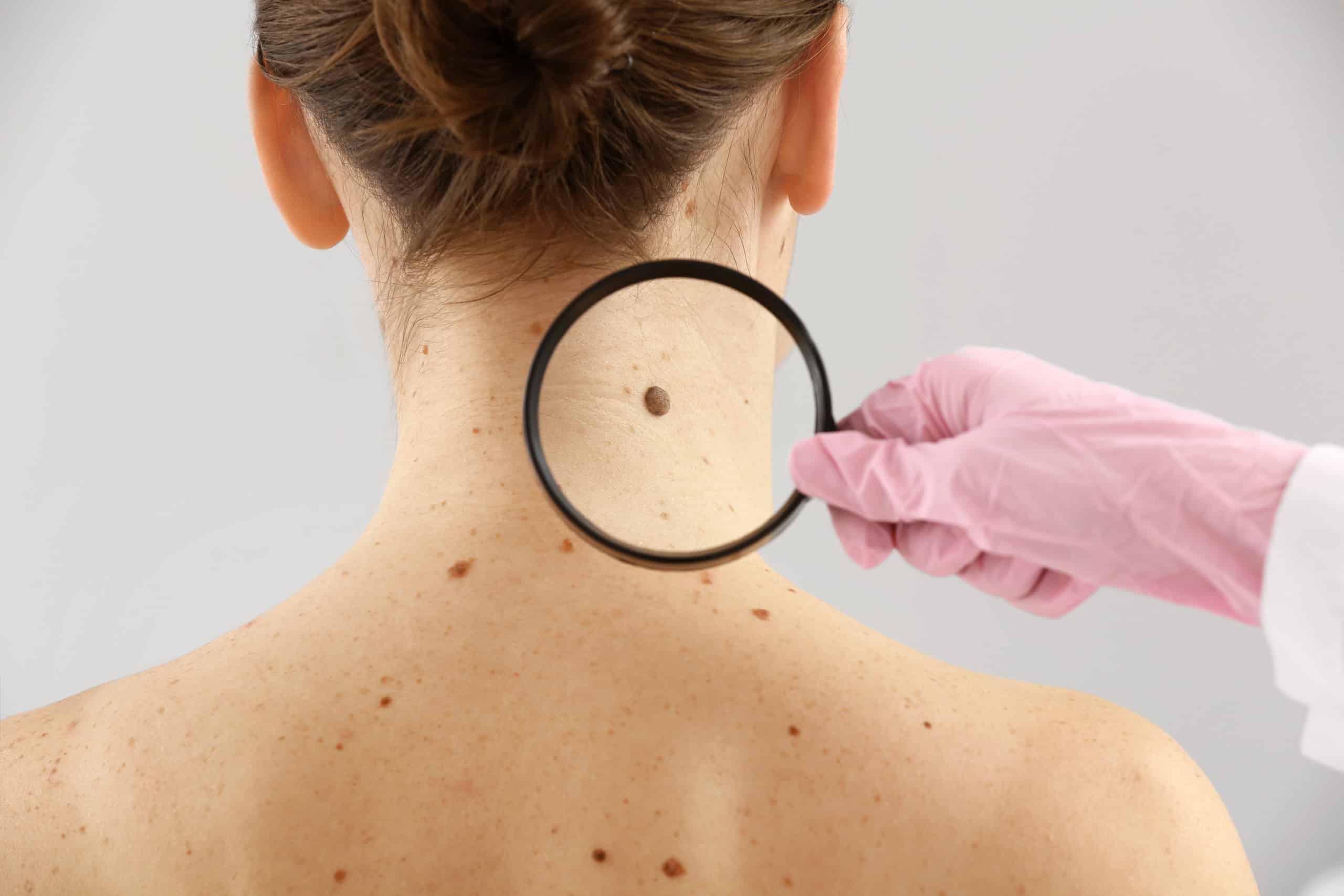 skin-cancer-screenings-and-treatment