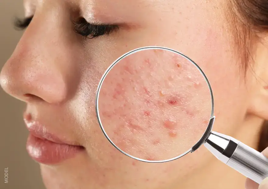 magnified view of skin with acne on a young woman's face