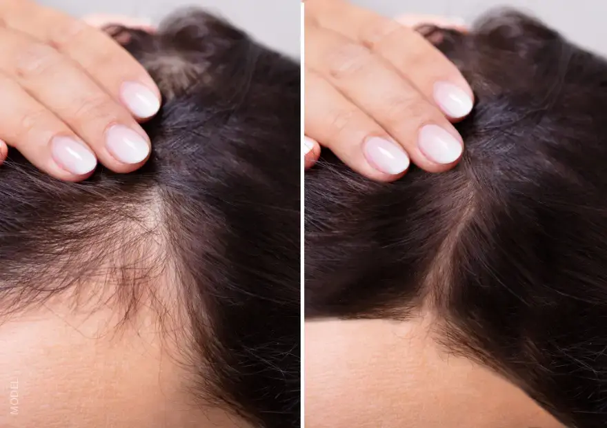 before and after illustration of hair loss vs full hair