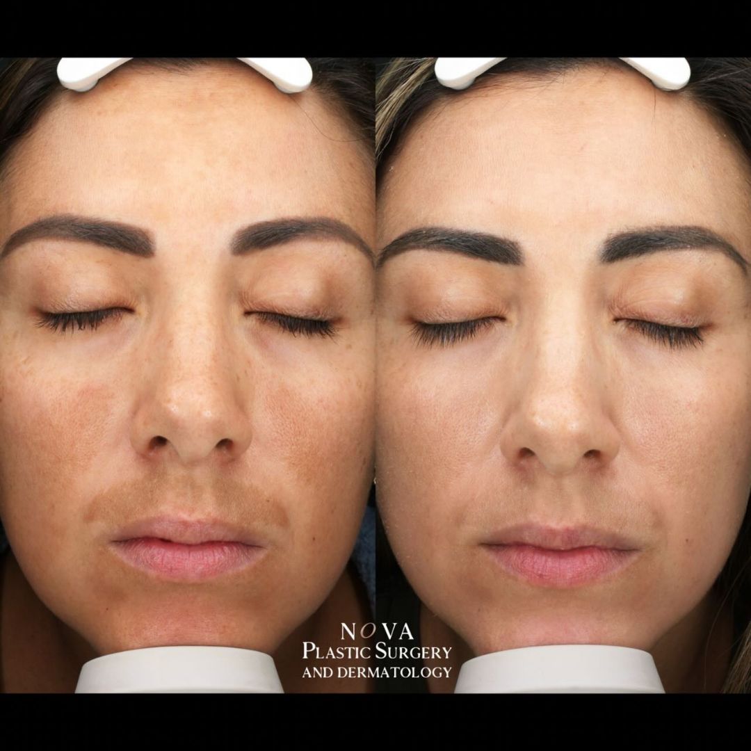 moxi laser before and after treatment