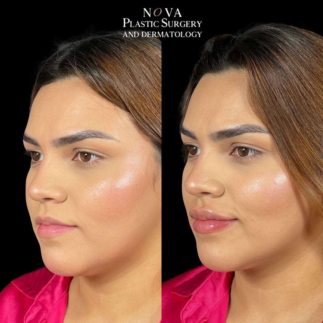 before and after restylane refyne treatment