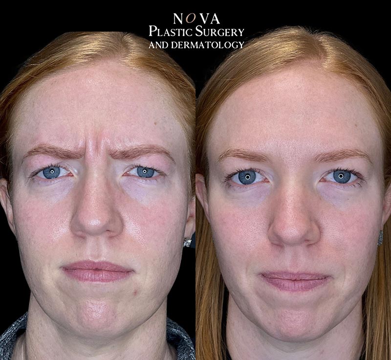 before and after of NOVA Plastic Surgery and Dermatology BOTOX® Cosmetic patient. Results may vary.