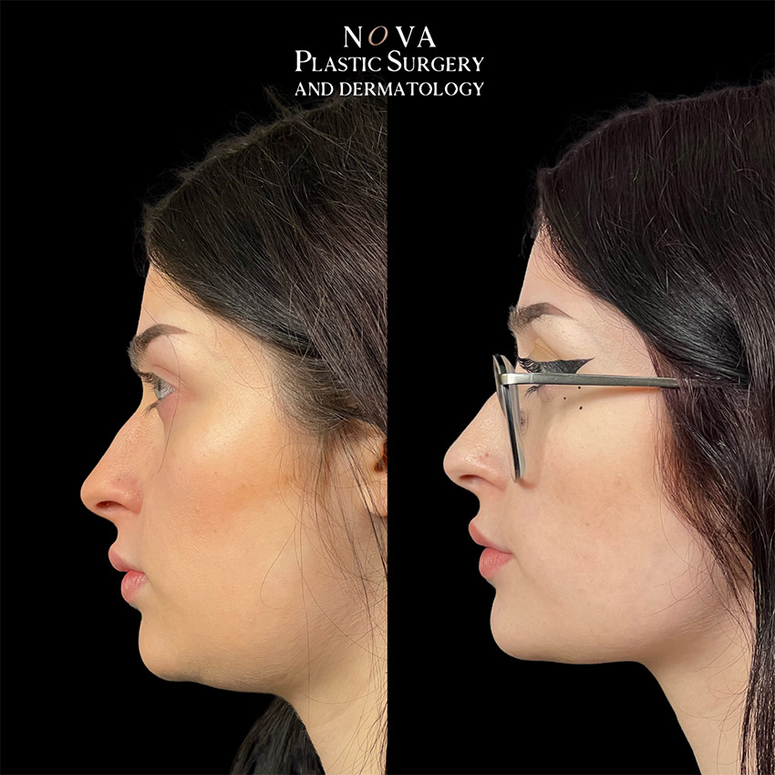 before and after photo of a NOVA Plastic Surgery and Dermatology KYBELLA® patient. Results may vary.